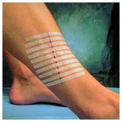 SUTURES 3M STERI STRIP...